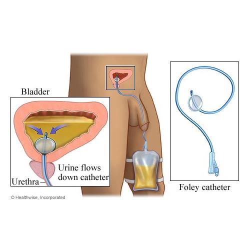 ΣΕΤ ΑΛΛΑΓΗΣ ΟΥΡΟΚΑΘΕΤΗΡΑ