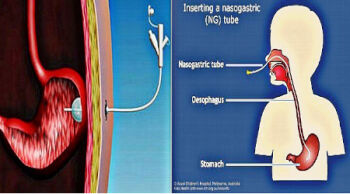 Γαστροστομία & Ρινoγαστρικός σωλήνας ( Levin)