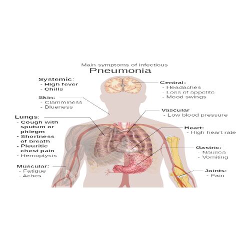 Πνευμονία: Συμπτώματα και αντιμετώπιση 