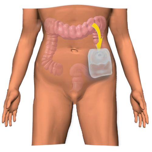 Φροντίδα στομίων και εκπαίδευση