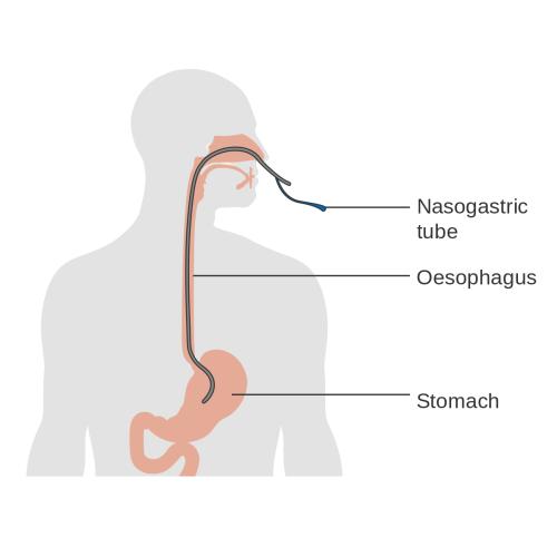 Εντερική σίτιση