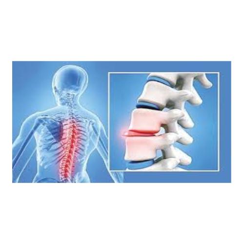 Κήλη Μεσοσπονδύλιου Δίσκου 