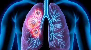 Καρκίνος του Πνεύμονα: Αντιμετωπίζοντας ένα παγκόσμιο εχθρό!