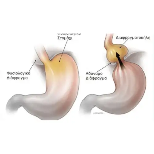 &Delta;&iota;&alpha;&phi;&rho;&alpha;&gamma;&mu;&alpha;&tau;&omicron;&kappa;ή&lambda;&eta; : &Tau;ί &epsilon;ί&nu;&alpha;&iota; & &tau;&rho;ό&pi;&omicron;&iota; &alpha;&nu;&tau;&iota;&mu;&epsilon;&tau;ώ&pi;&iota;&sigma;&eta;&sigmaf;.