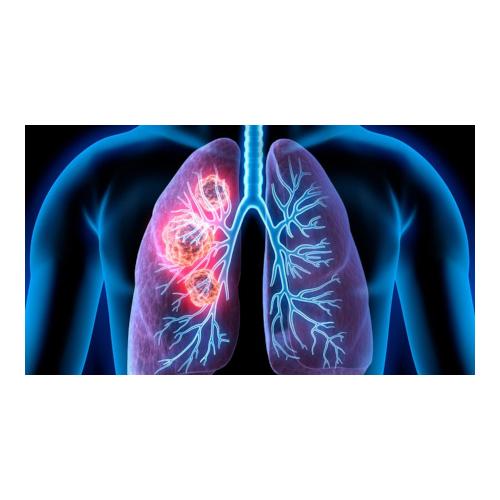 Καρκίνος του Πνεύμονα: Αντιμετωπίζοντας ένα παγκόσμιο εχθρό!