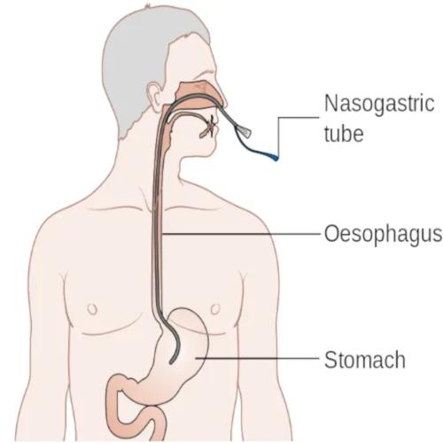 Καθετήρας Σίτισης (Levin) - 125cm | Συσκ: 5 Τμχ | Νο 18 Κόκκινο